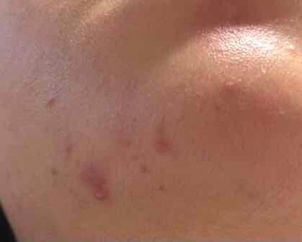 薬用保湿化粧水/オードムーゲ/化粧水を使ったクチコミ(5枚目)