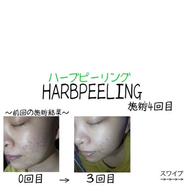 ほたて on LIPS 「施術4回目のハーブピーリングでした🌿1枚目は、0回目→前回　の..」（1枚目）