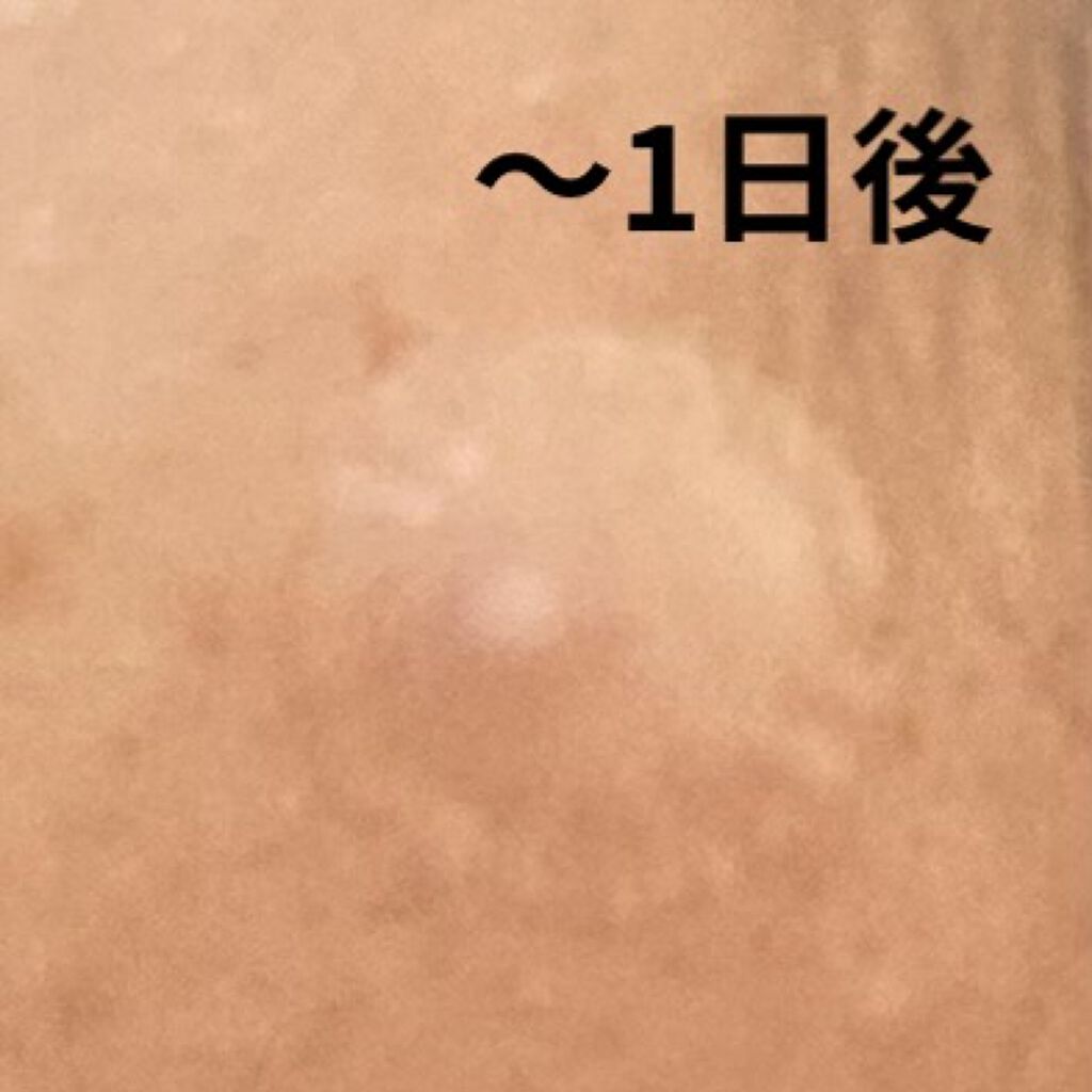 プロCICA クリアスポットパッチ/VT/その他スキンケアを使ったクチコミ（3枚目）