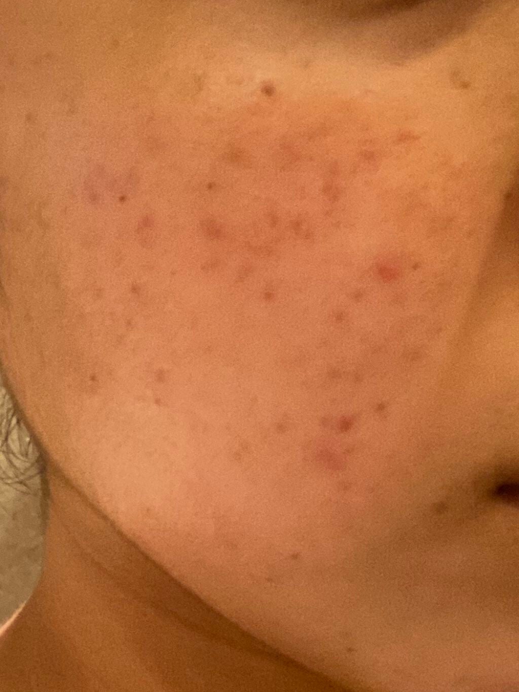 赤ニキさん on LIPS 「最近投稿全然してない😰😰この写真の時は五月くらいで、エピデュオ..」(1枚目)