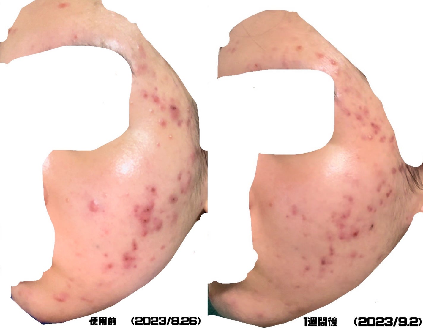 みこ on LIPS 「【ニキビ治療経過記録】閲覧注意です!!小学生の頃からニキビに悩..」(4枚目)