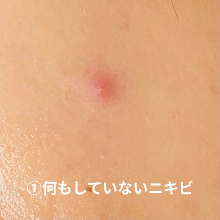 薬用ニキビケア スポッツクリーム/アクネスラボ/フェイスクリームを使ったクチコミ(5枚目)