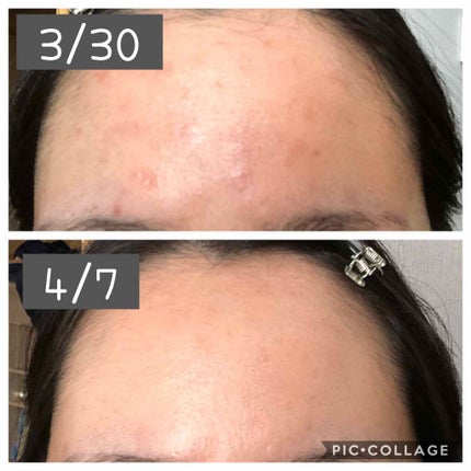 Ⅲ トライアルセット/NOV/トライアルキットを使ったクチコミ(2枚目)