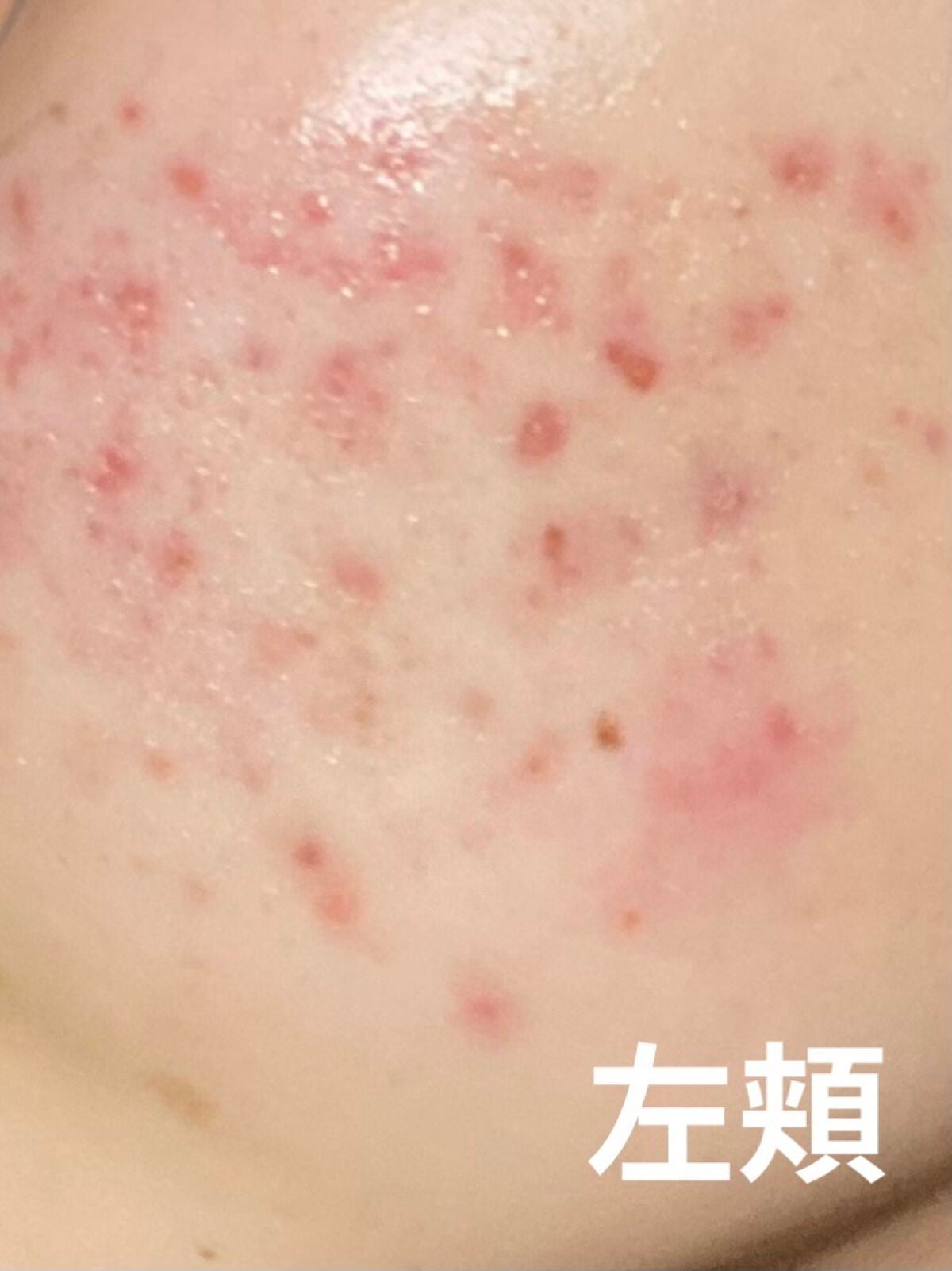 薬用 しみ 集中対策 美容液/メラノCC/美容液を使ったクチコミ(2枚目)