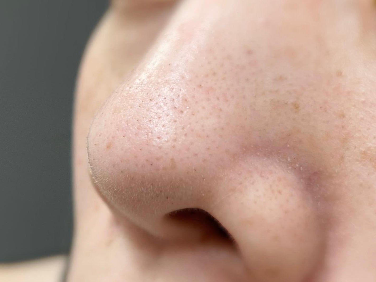 natsu on LIPS 「...自分の詰まり毛穴を見せるのは超恥ずかしいけど載せます🫣黒..」(3枚目)