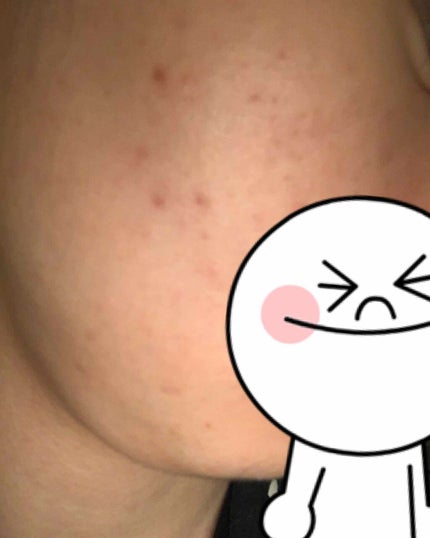 ディフェリンゲル0.1% /マルホ株式会社/その他を使ったクチコミ(1枚目)