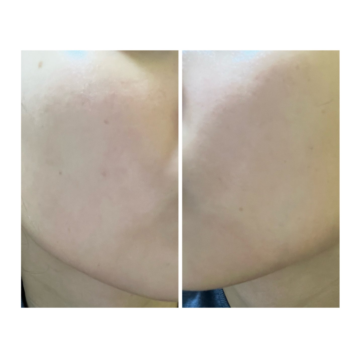 ぽむ on LIPS 「2023.9.13皮膚科に受診 エピデュオとヘパリン処方1枚目..」(1枚目)