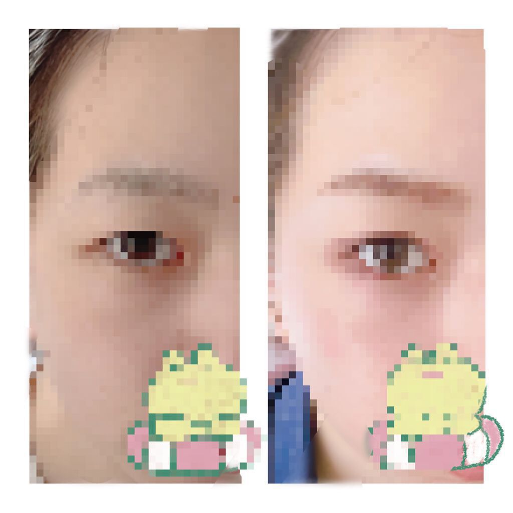 のびーるアイテープ（絆創膏タイプ、レギュラー）/DAISO/二重まぶた用アイテムを使ったクチコミ（1枚目）