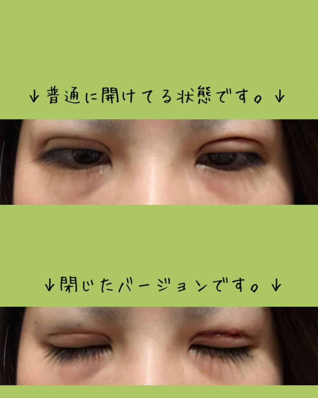 pipi on LIPS 「今までは見る専でしたが、今日思い切って二重整形したので、記録が..」(2枚目)