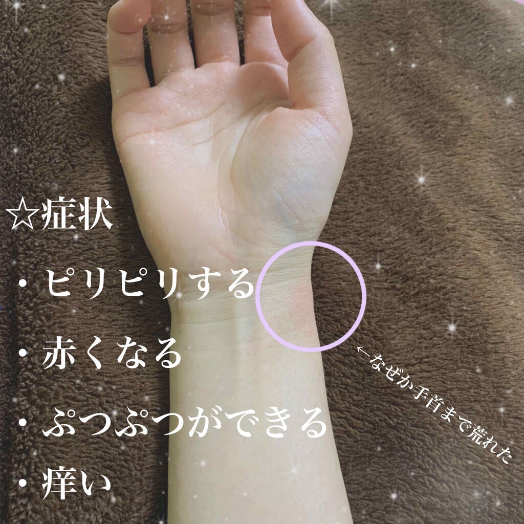 オロナインH軟膏 (医薬品)/オロナイン/その他を使ったクチコミ(3枚目)