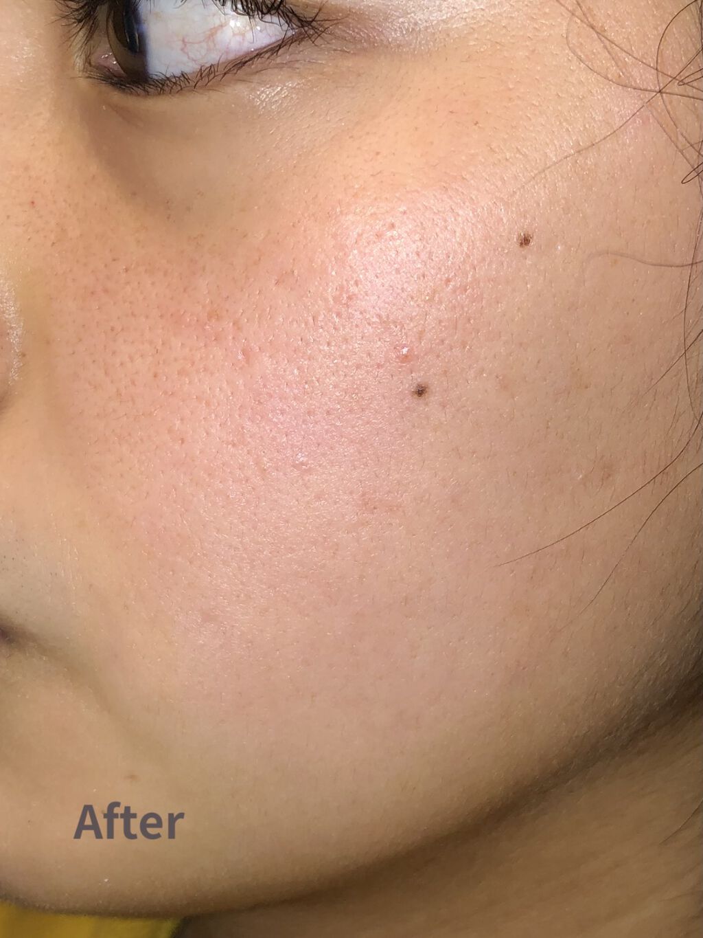 オードムーゲ 薬用ローション（ふきとり化粧水）/オードムーゲ/拭き取り化粧水を使ったクチコミ（3枚目）