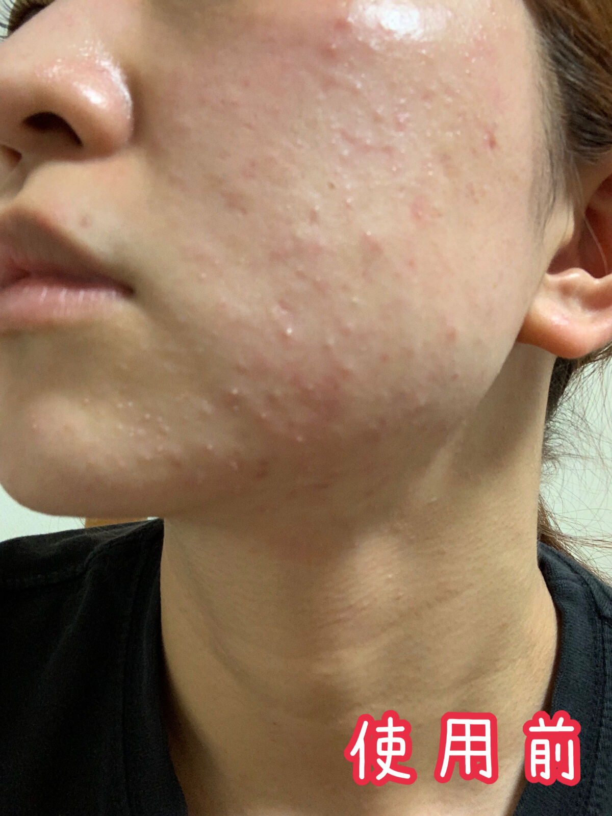 モイスチュア ローション/カルテHD/化粧水を使ったクチコミ（2枚目）