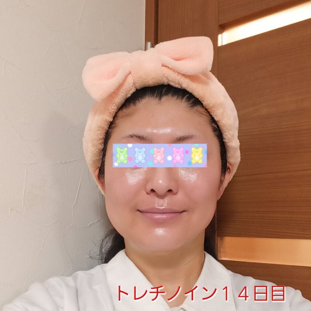 トレチノインジェル/A-Ret/美容液を使ったクチコミ(1枚目)