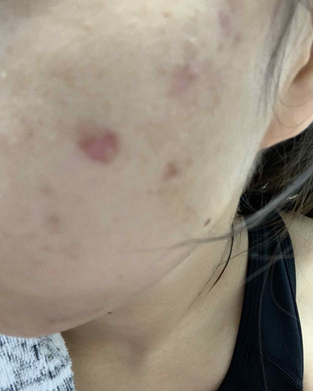 ニキビ治療薬クリーム (医薬品)/クレアラシル/その他を使ったクチコミ(2枚目)