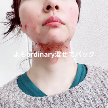 AHA 30% + BHA 2% Peeling Solution/The Ordinary/ピーリングを使ったクチコミ（1枚目）