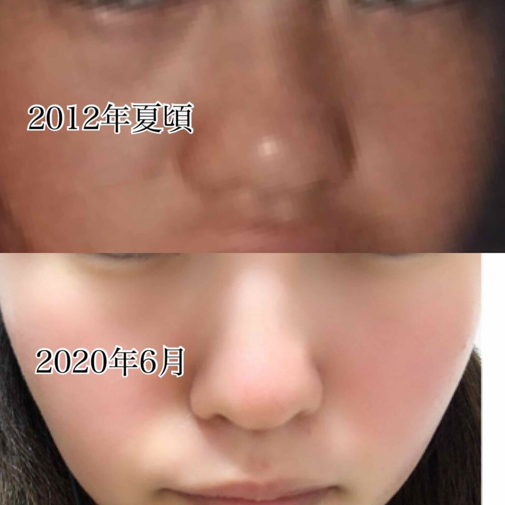 憂鬱 on LIPS 「こんにちは今回は、鼻についての投稿です。個人的には目より大きく..」(1枚目)