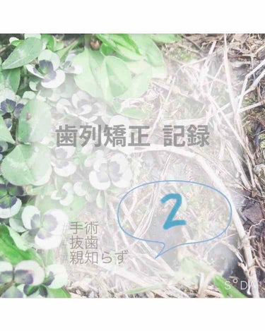 歯列矯正記録🦷  2
こんばんは！  田舎の住民🦎です🙌

今回は親知らずの抜歯について投稿しようと
思います！

私は歯列矯正を始める前に
埋まっている親知らずを2本、普通の歯を4本ぬきました😭

5