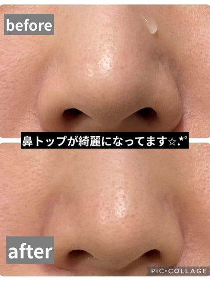 毛穴小町 ブラックピールオフパック/クリアターン/ピーリングを使ったクチコミ(6枚目)