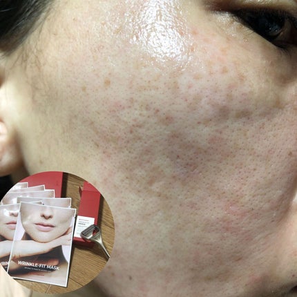 リンクルフィットマスク+ニードルローラー/MEDITHERAPY/美顔器・マッサージを使ったクチコミ(5枚目)