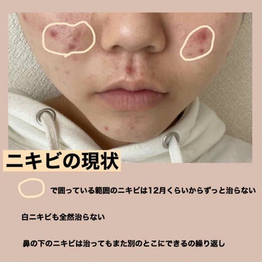 わこ on LIPS 「皮膚科に通っても美顔教室の化粧水使っても全く治らないニキビ😭彼..」（2枚目）