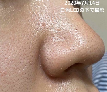 主婦A on LIPS 「#毛穴日記_DJケアナDJKeana（:Blackheads）..」（4枚目）