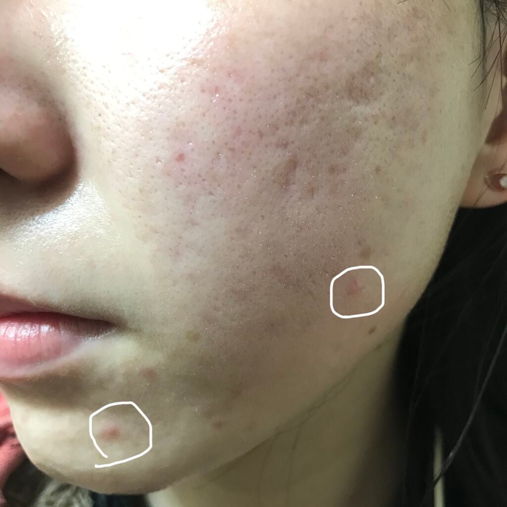 ティーツリーケア ソリューション エッセンシャルマスクEX/MEDIHEAL/シートマスク・パックを使ったクチコミ(2枚目)