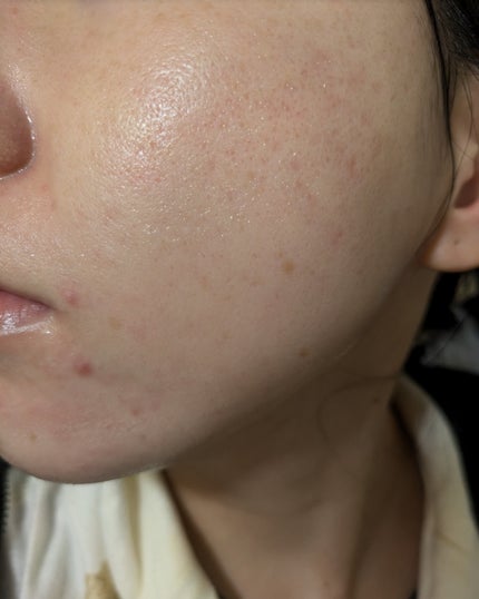 miina@汚肌工事録⚠️ on LIPS 「11/1の#汚肌工事録💐肌がのためにやっていること💊乳酸菌やビ..」(2枚目)