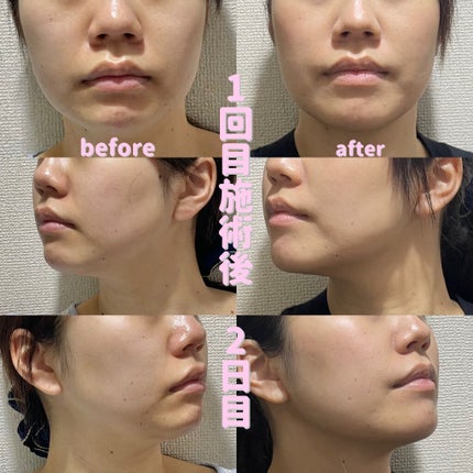 Tomomi on LIPS 「はじめての美容医療〜脂肪溶解リニアHIFU〜1回目施術後2日目..」(4枚目)