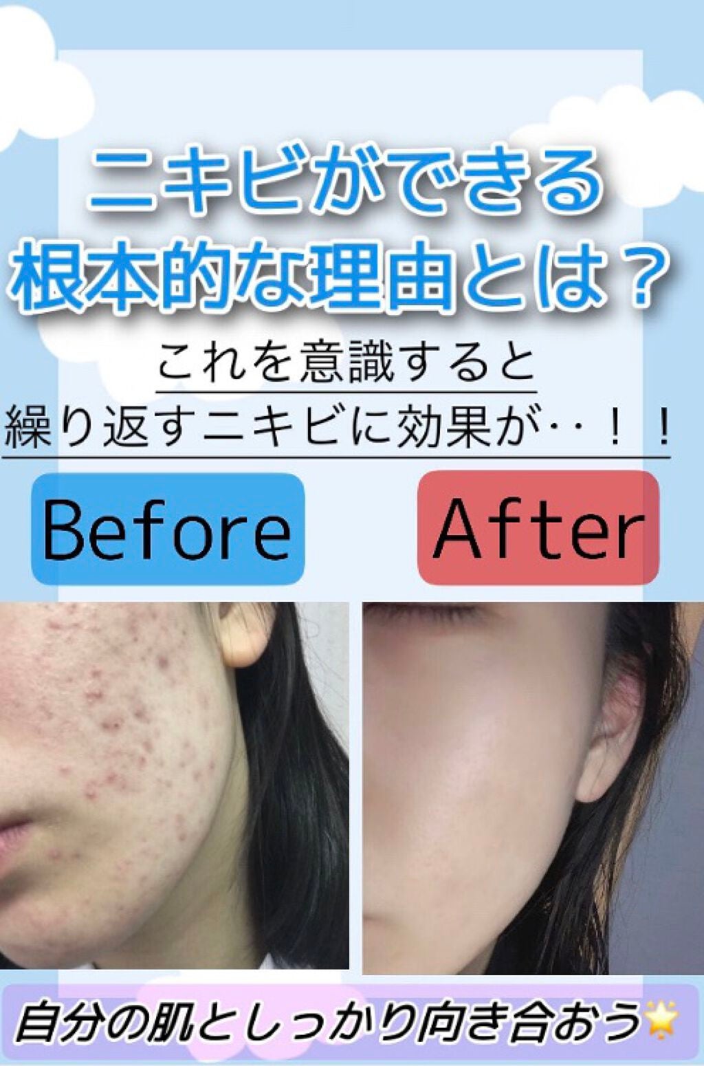 長柄カミソリ ビューティーm 貝印の口コミ ニキビはどうやってできるの ニキビの種類 By らん 混合肌 10代後半 Lips 長柄カミソリ ビューティーm 貝印の口コミ ニキビはどうやってできるの ニキビの種類 By らん 混合肌 10代後半 Lips