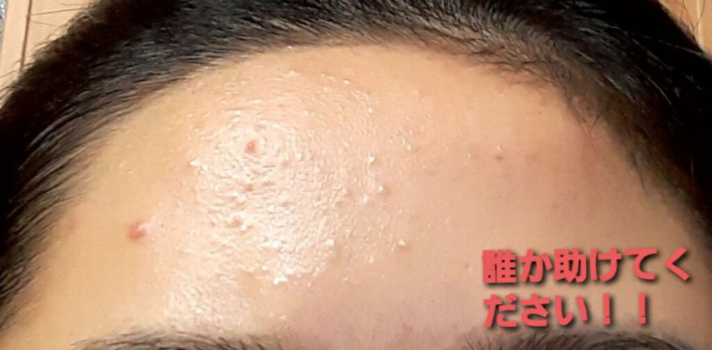 月 on LIPS 「ご観覧ありがとうございます!2枚目の写真を見ての通り、おでこの..」(2枚目)