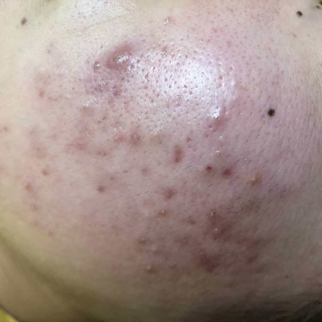 ハトムギ化粧水(ナチュリエ スキンコンディショナー R )/ナチュリエ/化粧水を使ったクチコミ（2枚目）