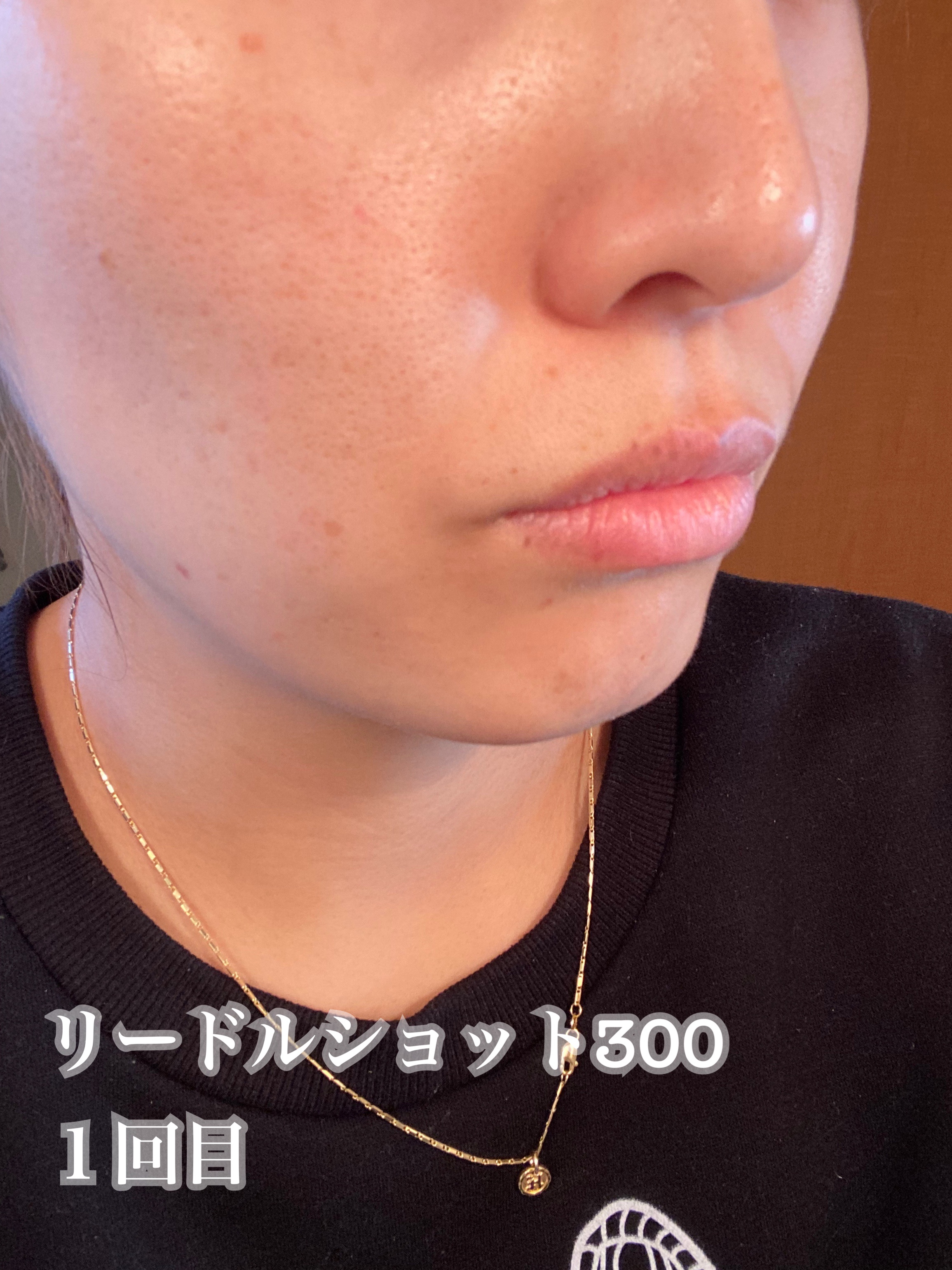 リードルショット300/VT/美容液を使ったクチコミ（2枚目）