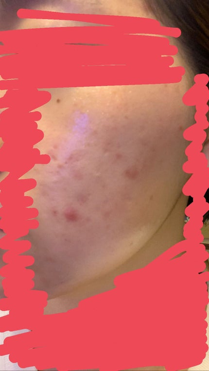 ベピオゲル/マルホ株式会社/その他を使ったクチコミ(2枚目)