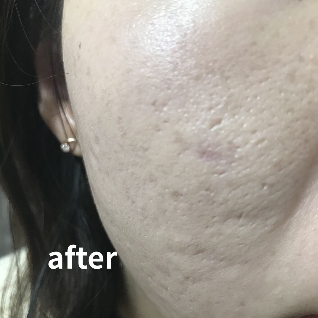 the SAEM ミネラライジング ポア コンシーラーのクチコミ「開き毛穴を埋めたくて…はぁ

(有名じゃない方！)



💡the SAEM
ミネラライジング.....」（3枚目）