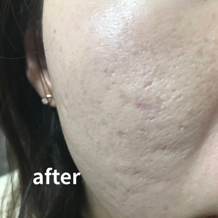 ミネラライジング ポア コンシーラー/the SAEM/リキッドコンシーラーを使ったクチコミ(3枚目)