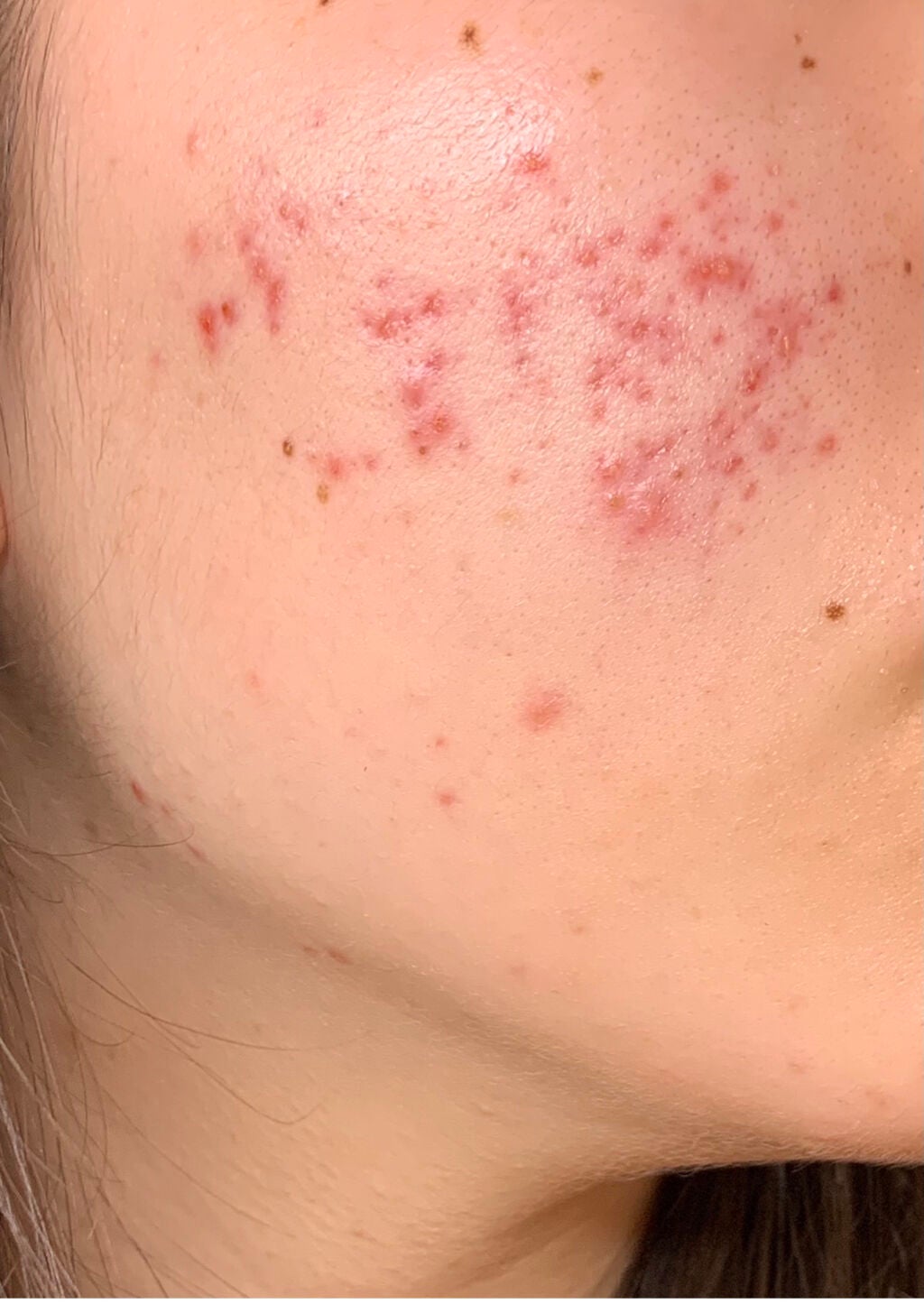 supreme_lips_xhi on LIPS 「至急!ニキビをなるべく早く完治させる方法を教えてください!再発..」(4枚目)