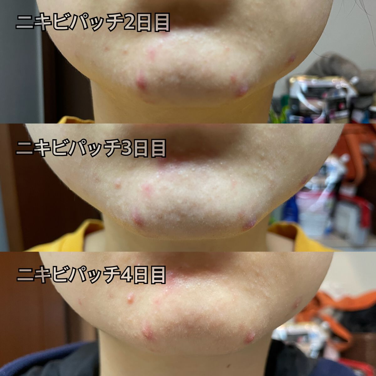 プロCICA クリアスポットパッチ/VT/その他スキンケアを使ったクチコミ(1枚目)