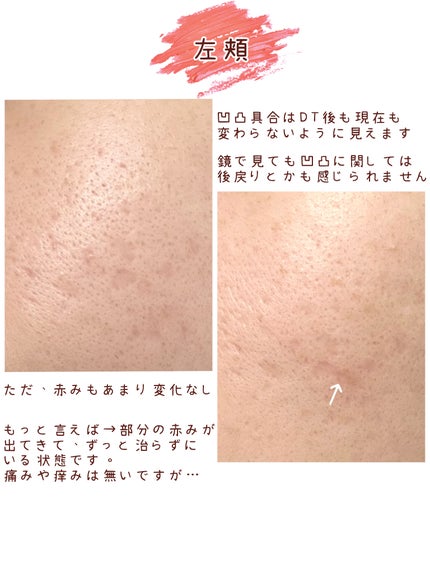 V on LIPS 「クレーター治療備忘録part4です。前回の投稿から5ヶ月が経ち..」(2枚目)