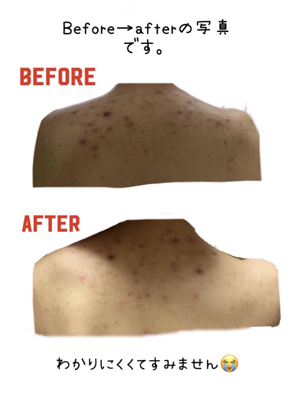 ティーツリーアンティセプティックバーム/Tea Tree Therapy/フェイスバームを使ったクチコミ（3枚目）