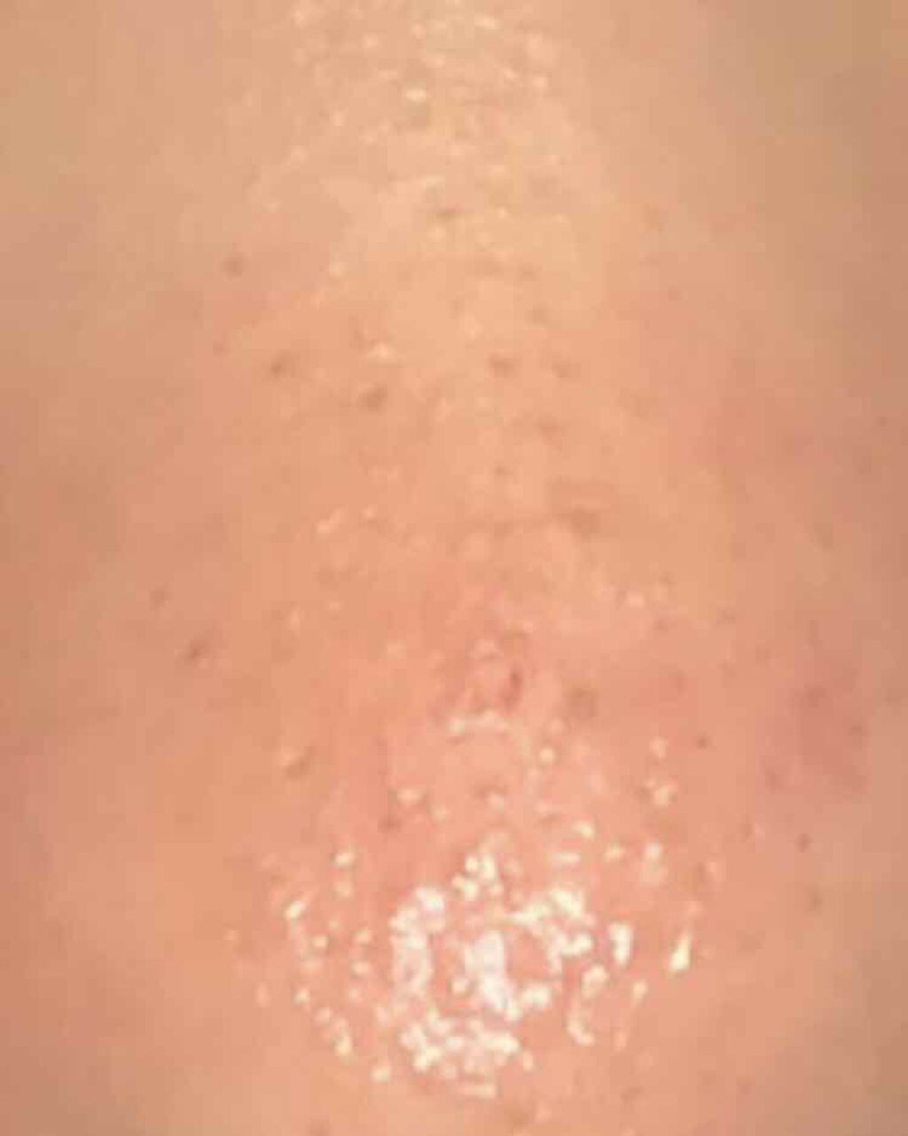 デュアック配合ゲル/ポーラファルマ/その他を使ったクチコミ（3枚目）