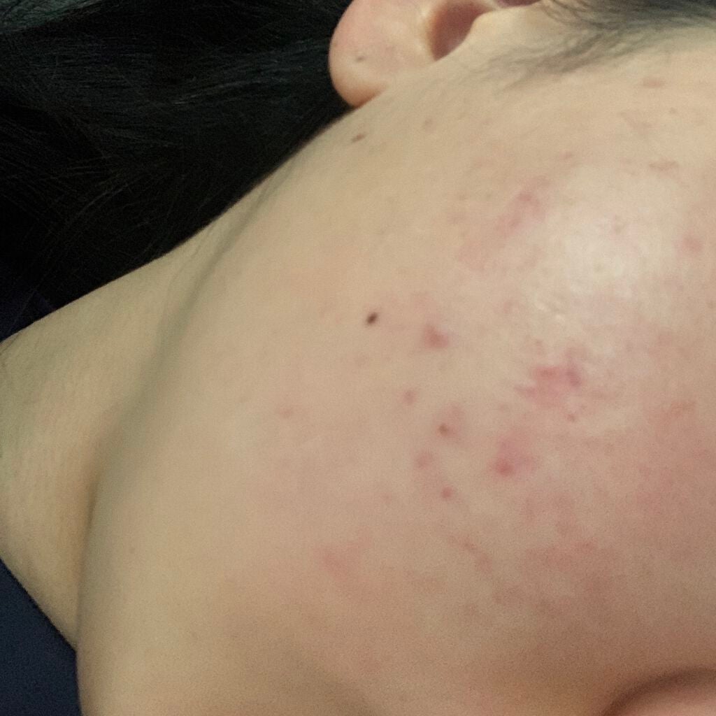 space on LIPS 「ほんまに薄くなってきたなあ!と感じるこの頃!新しいニキビも出に..」(1枚目)