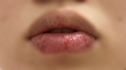 ももっちゅ on LIPS 「助けてください🥺🥺🥺🥺(閲覧注意‼️)つい唇の乾いた皮を向いて..」(1枚目)