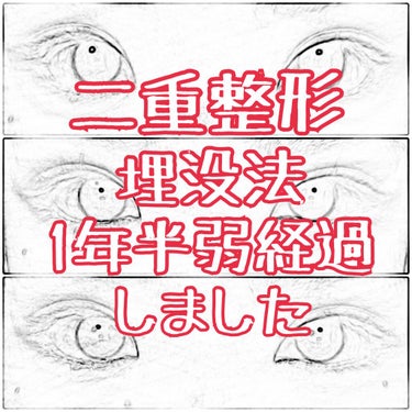 🙌整形レポ🙌


皆さまお久しぶりです💗

去年の5月に二重整形をし、
かれこれ約1年半弱経ちました、、、。

整形するか悩んでいる方に
少しでも参考になればと思い、、
その後の写真載せときます！！
(