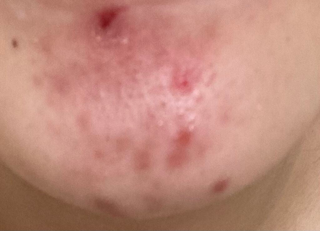 fresh_lips_jkd1 on LIPS 「とても汚い肌をお見せしてしまい申し訳ありません(--;)ニキビ..」(4枚目)