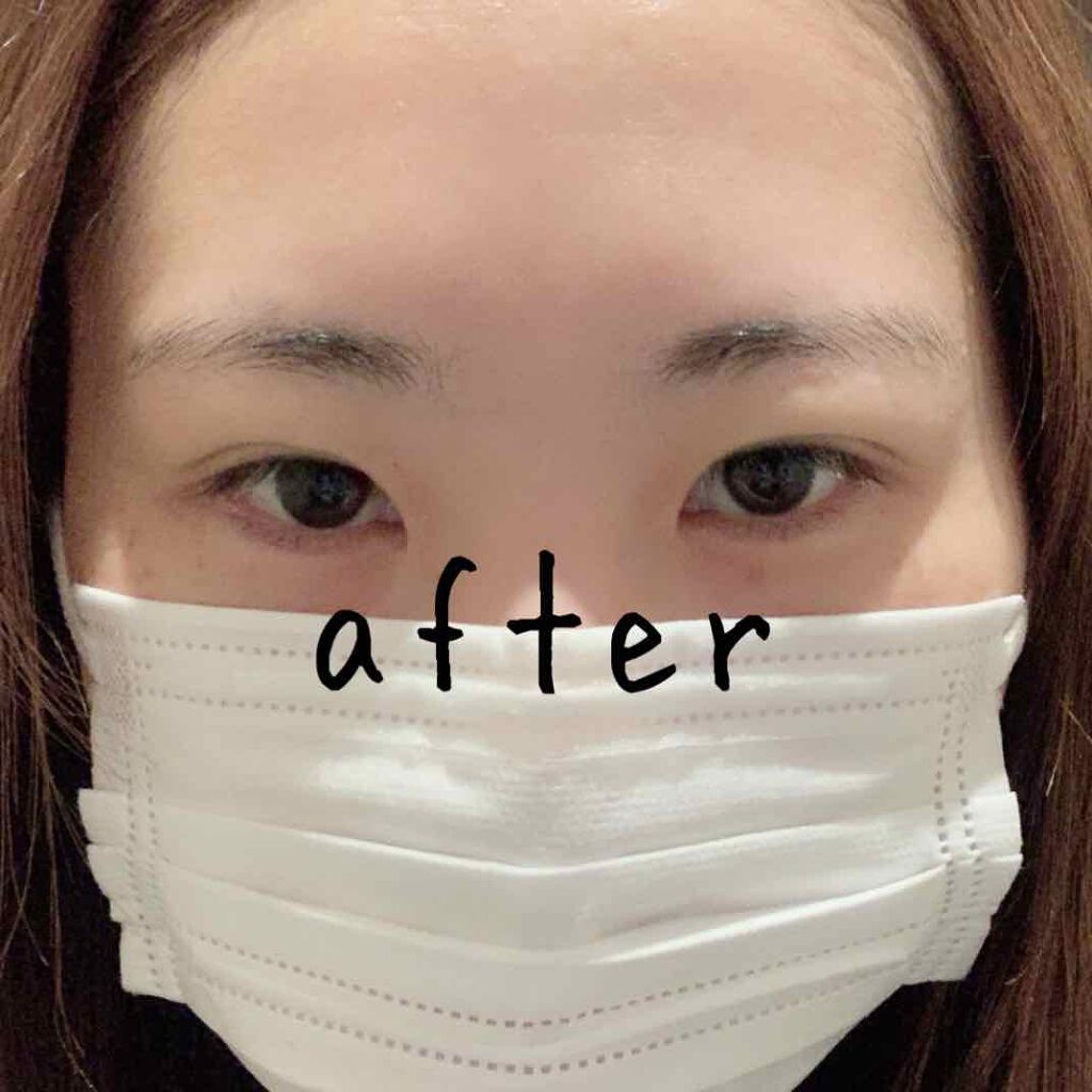 さとう on LIPS 「はじめまして。湘南美容クリニックで二重整形をしてきましたのでレ..」(2枚目)