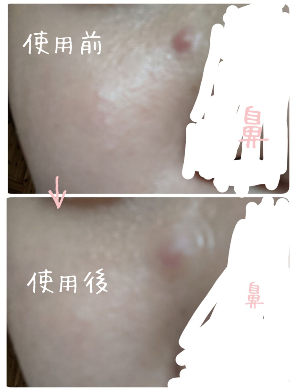 ゼロスポットパッチ/Today’s Cosme/にきびパッチを使ったクチコミ(3枚目)