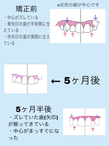 歯間ブラシ I字型15P/デンタルプロ/デンタルフロス・歯間ブラシを使ったクチコミ(2枚目)