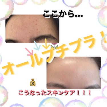 SENKA（専科） パーフェクトホイップ アクネケアのクチコミ「【垢抜け】オールプチプラ！！ニキビだらけの肌がツルッツル肌に！！！当時使っていた商品をご紹介！.....」（1枚目）