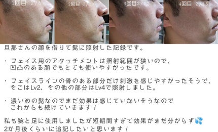 光美容器 光エステ <ボディ&フェイス用> ES-WP97/Panasonic/家庭用脱毛器を使ったクチコミ(5枚目)