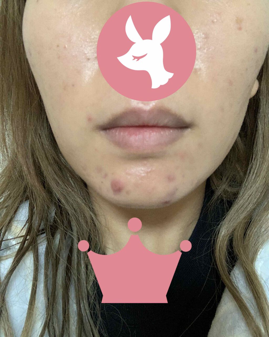 十味敗毒湯 ジュウミハイドクトウ(医薬品)/クラシエ薬品/その他を使ったクチコミ(1枚目)